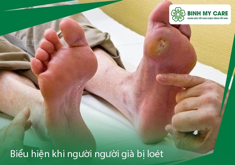 cham-soc-nguoi-gia-bi-loet-2