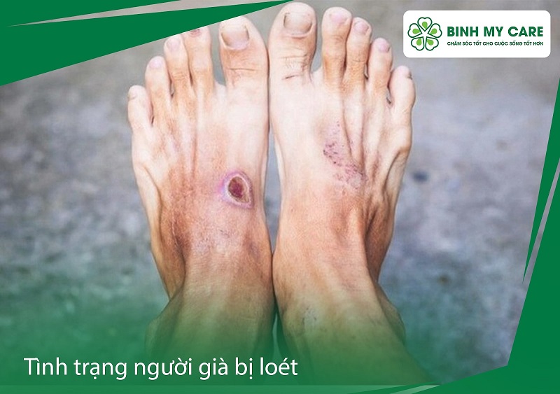 cham-soc-nguoi-gia-bi-loet-3